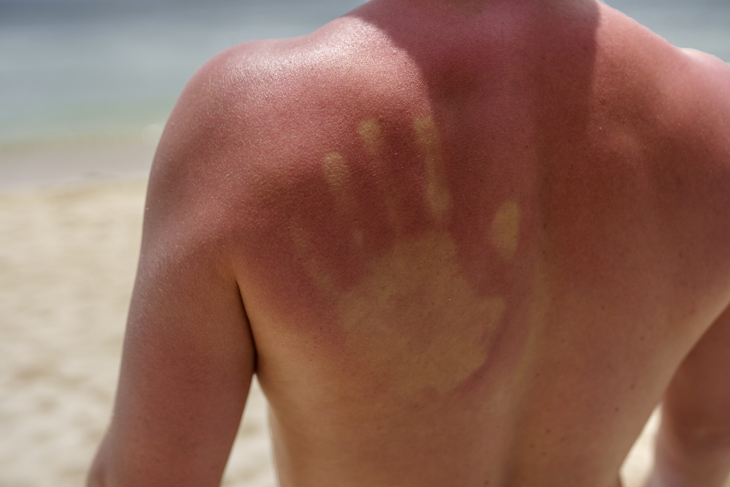 ga pakai sunscreen merupakan kebiasaan buruk, karena Sinar matahari jadi salah satu masalah yang bisa merusak kulit, bisa bikin penuaan dini dan bintik-bintik hitam.